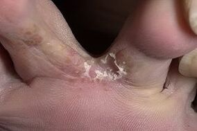 symptômes de champignon sur les pieds
