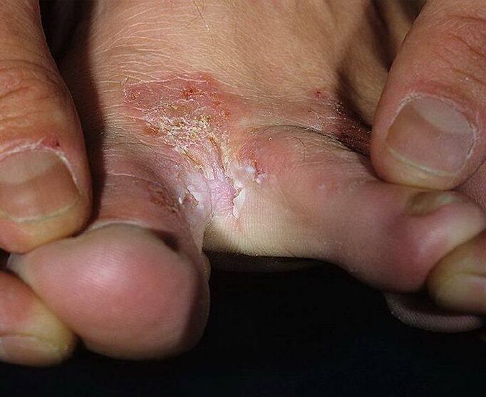 Symptômes de mycose des pieds