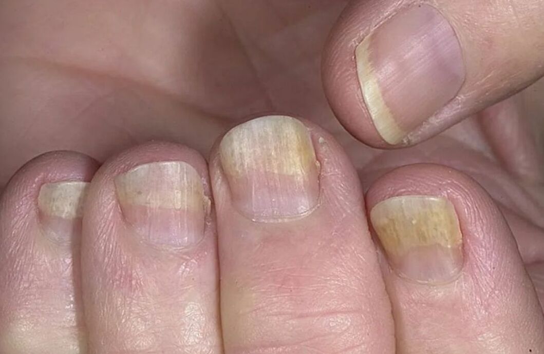 Symptômes de la mycose des ongles