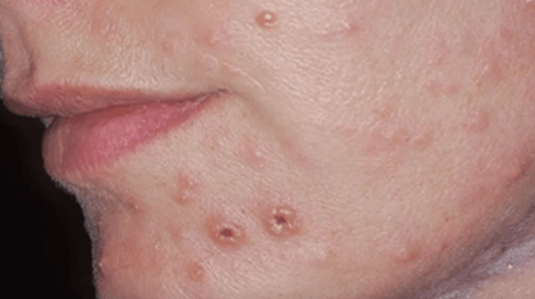 Infection fongique de la peau du visage