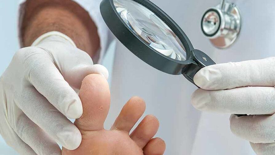 Le diagnostic de mycose des ongles des pieds est effectué par un dermatologue