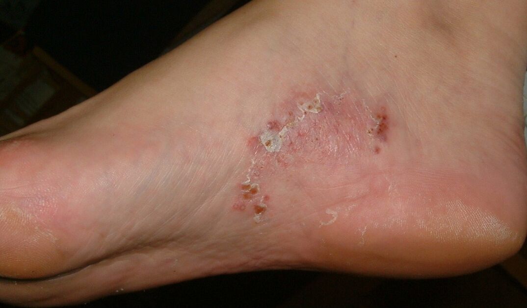 Manifestations d'une infection fongique sur le pied